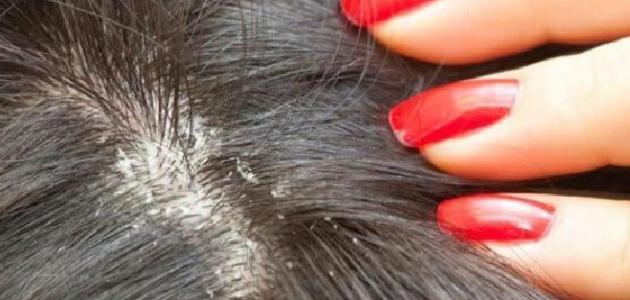 فوائد الخل للقمل فوائد الخل للقمل