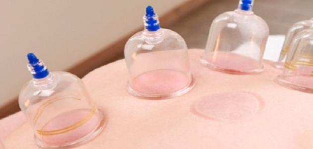 فوائد كاسات الهواء للجسم فوائد كاسات الهواء للجسم