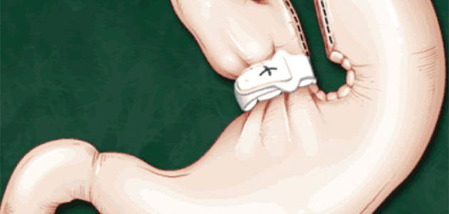 فوائد وأضرار تكميم المعدة فوائد وأضرار تكميم المعدة