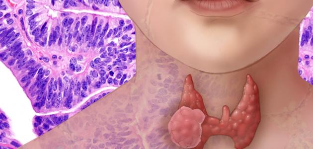 قصور الغدة الدرقية وأعراضها وعلاجها