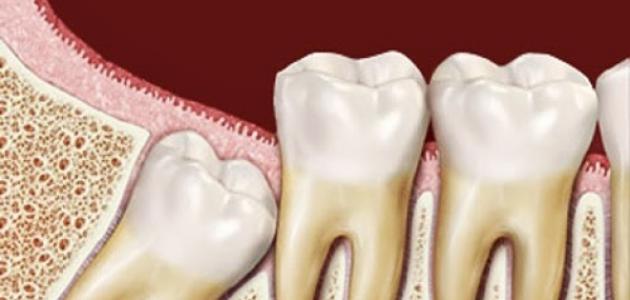 كم جذر لضرس العقل كم جذر لضرس العقل