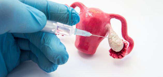 كيفية التخلص من التكيس المبايض كيفية التخلص من التكيس المبايض