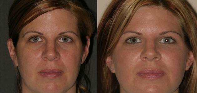 كيفية حرق دهون الوجه كيفية حرق دهون الوجه