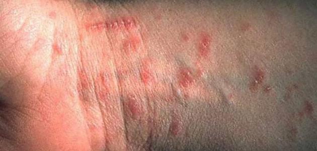 كيفية علاج الجرب كيفية علاج الجرب