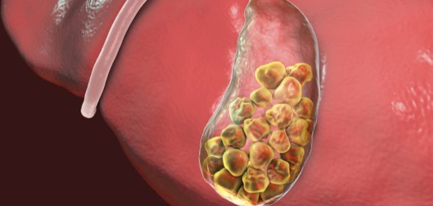 كيفية علاج حصى المرارة