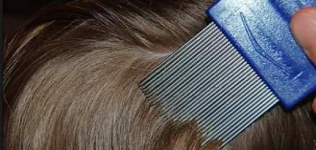 كيفية علاج قمل الرأس كيفية علاج قمل الرأس