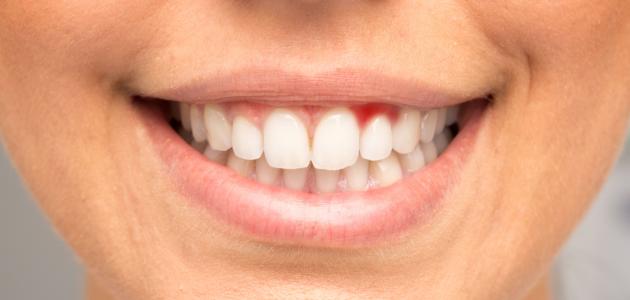 كيفية علاج نزيف اللثة كيفية علاج نزيف اللثة