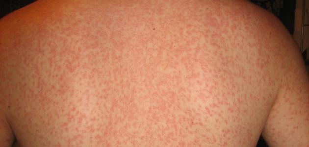 كيفية عمل اختبار حساسية البنسلين