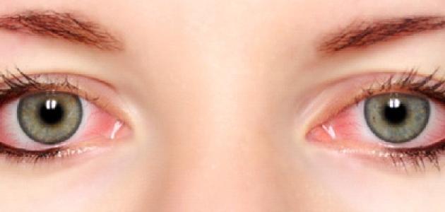كيفية عمل كمادات للعين كيفية عمل كمادات للعين