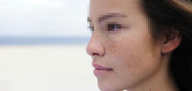 كيف أتجنب كلف الحمل كيف أتجنب كلف الحمل