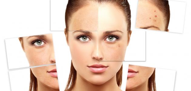 كيف أخفي حب الشباب