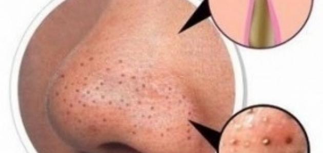 كيف تتم إزالة الرؤوس السوداء كيف تتم إزالة الرؤوس السوداء