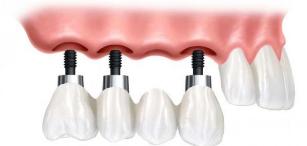 كيف تتم زراعة الأسنان كيف تتم زراعة الأسنان