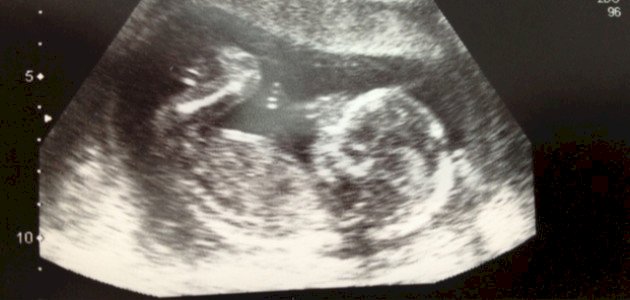 كيف شكل الجنين في الشهر الرابع