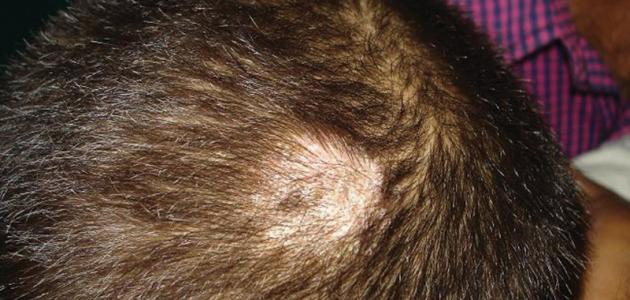 ما أسباب الثعلبة