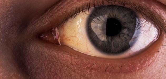 ما أسباب اليرقان ما أسباب اليرقان