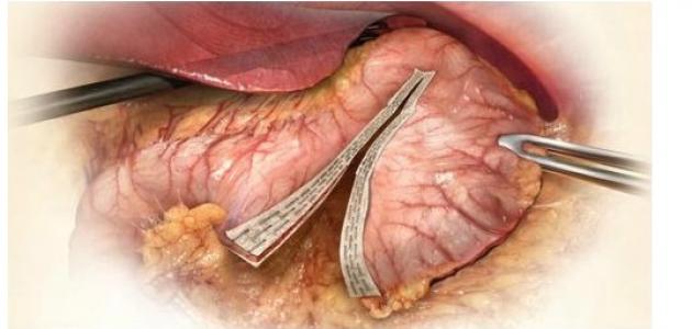 ما بعد عملية تكميم المعدة ما بعد عملية تكميم المعدة