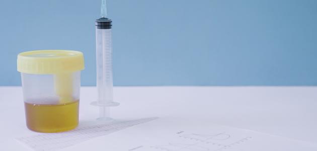 ما سبب تغير لون البول الى أصفر غامق ما سبب تغير لون البول الى أصفر غامق