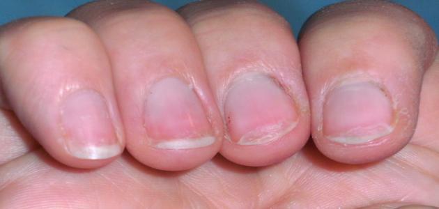 ما سبب تقصف الأظافر ما سبب تقصف الأظافر