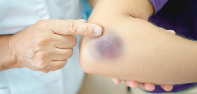 ما سبب ظهور كدمات في الجسم بدون سبب ما سبب ظهور كدمات في الجسم بدون سبب