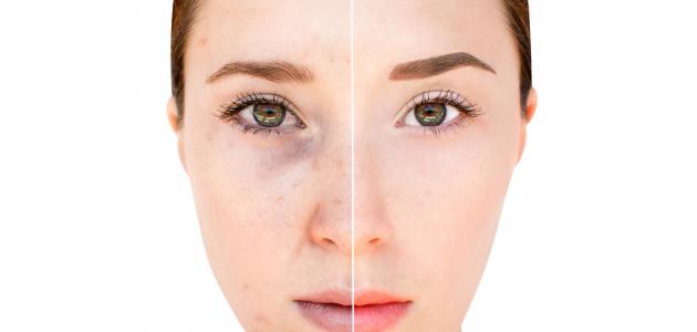 ما علاج تصبغات الوجه