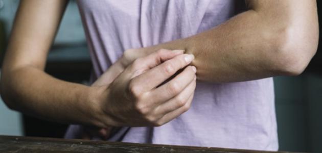 ما هو التهاب الجلد الدهني