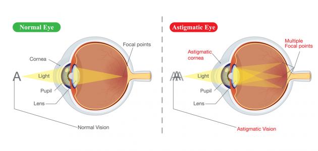 ما هو انحراف النظر ما هو انحراف النظر