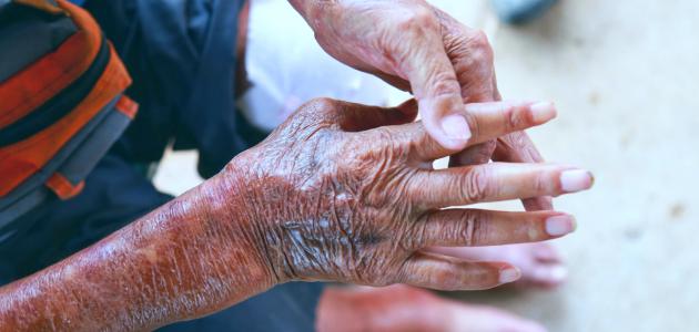 ما هو تليف الجلد ما هو تليف الجلد