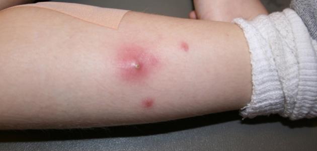 ما هو سبب ظهور الدمامل ما هو سبب ظهور الدمامل