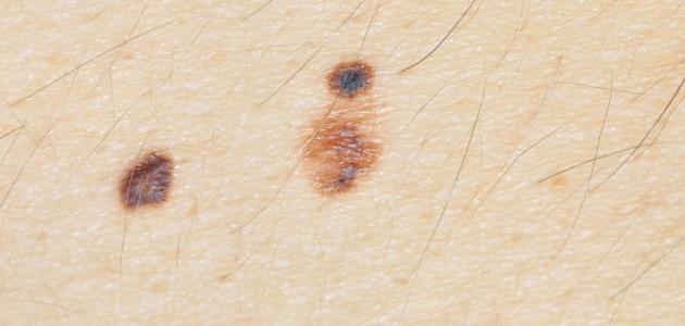 ما هو سبب ظهور الشامات ما هو سبب ظهور الشامات