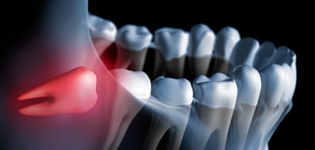 ما هو ضرس العقل ما هو ضرس العقل