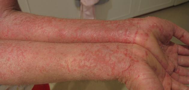 ما هو علاج الأكزيما ما هو علاج الأكزيما