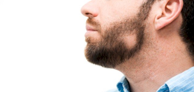 ما هو علاج الثعلبة في الذقن ما هو علاج الثعلبة في الذقن