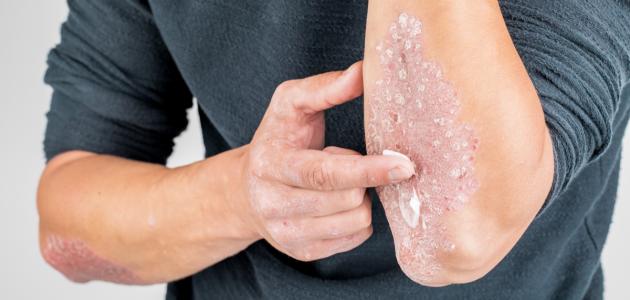 ما هو علاج الصدفية ما هو علاج الصدفية