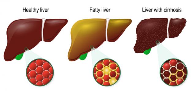 ما هو علاج تليف الكبد
