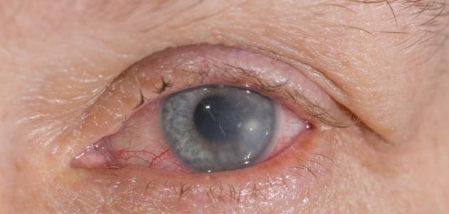 ما هو علاج قرحة القرنية ما هو علاج قرحة القرنية