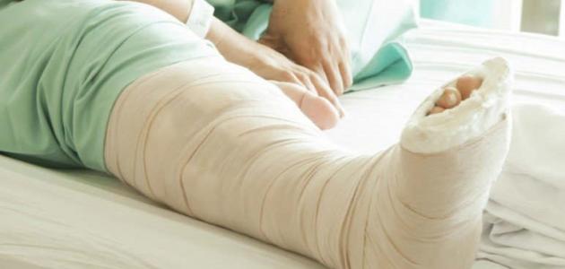 ما هو علاج كسور العظام ومضاعفاته - فيديو