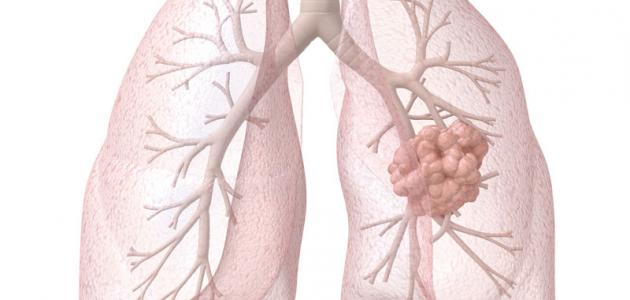 ما هو علاج مرض ذات الرئة