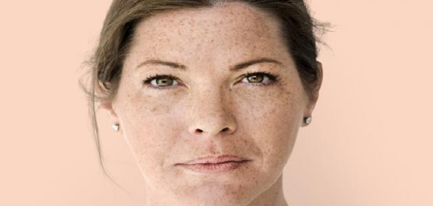 ما هو كلف الحمل ما هو كلف الحمل