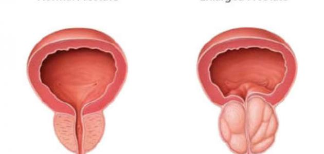 ما هو مرض البروستات ما هو مرض البروستات