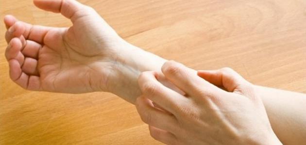 ما هو مرض الجرب أو الحكاك - فيديو