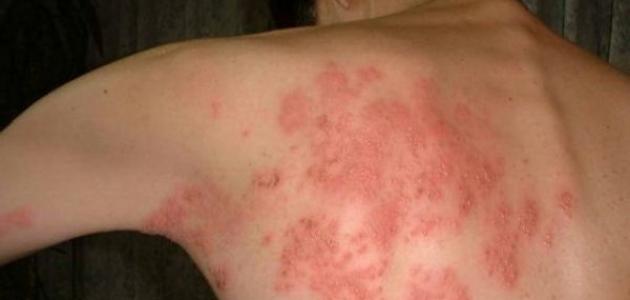 ما هو مرض الحزام الناري (الهربس العصبي) ما هو مرض الحزام الناري (الهربس العصبي)