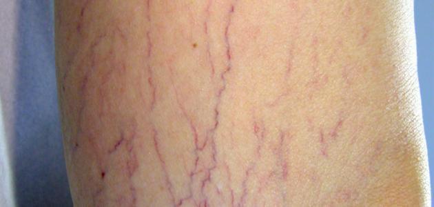 ما هو مرض الدوالي ما هو مرض الدوالي