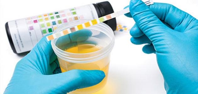 ما هي أسباب حرقة البول - فيديو