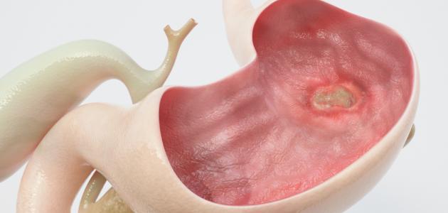 ما هي أسباب قرحة المعدة