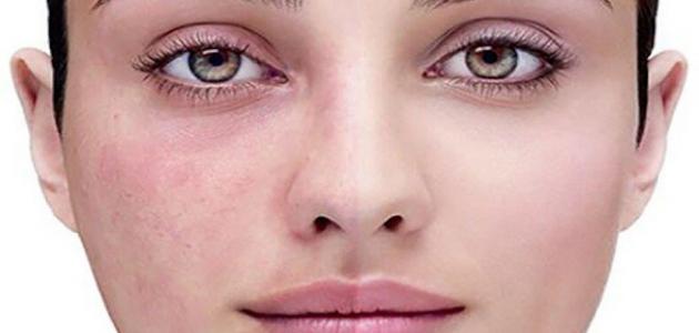 ما هي أسباب مرض الوردية ما هي أسباب مرض الوردية