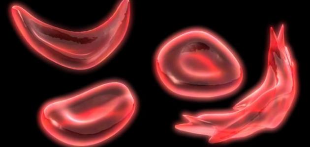 ما هي أعراض الأنيميا عند الأطفال ما هي أعراض الأنيميا عند الأطفال