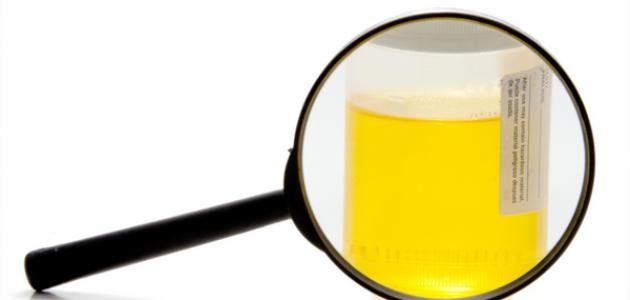 ما هي أعراض التهاب البول ما هي أعراض التهاب البول