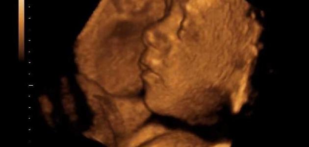 ما هي أعراض تشوهات الجنين ما هي أعراض تشوهات الجنين