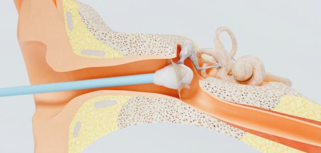 ما هي أعراض ثقب طبلة الأذن ما هي أعراض ثقب طبلة الأذن